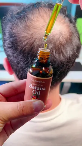 How to regrow hair naturally #batana #oil #hair #growth #serum #organic #natural #haircare #healthyhair #reducehairloss #tiktokshop #tiktokmademebuyit #flashsale #dealsforyoudays#hairgrowth#crazyfridaydeals#baldness#gypsophila #GypsophilaBatanaoil
