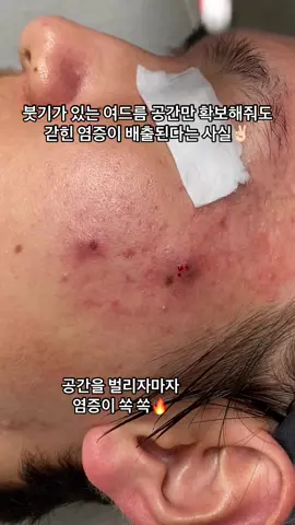 #여드름 #염증 . 붓기와 통증이 동반된 여드름은 무작정 압을 가해 제거하는게 아닌 공간만 자극없이 확보해줘도 갇힌 염증이 배출된다는 사실🔥 공간을 벌리자마자 갇혀있던 염증이 쏙쏙 깨끗하게 나오는게 보이실까요?✌🏻 #대구피부과 #대구피부관리 #동성로피부과 #동성로피부관리 #여드름압출 #압출 #압출영상 #피부과 #피부관리 #수성구피부과 #경산피부과 #구미피부과 #칠곡피부과 #달서구피부과 #영천피부과 #범어피부과 #하양피부과 #김천피부과 #청도피부과 #성서피부과 #대구가꾸다 