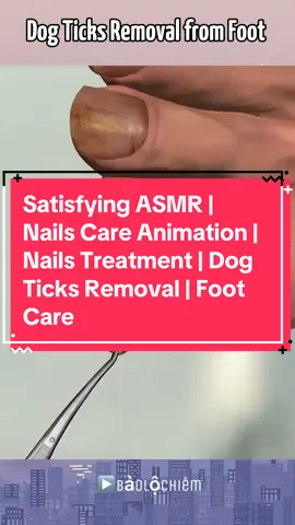 Satisfying ASMR | Nails Care Animation | Nails Treatment | Dog Ticks Removal | Foot Care | Nail Cleaning #satisfying #asmr #calmcareclinic #cleaning #feetcleaning #footcare #귀지제거 #nails 