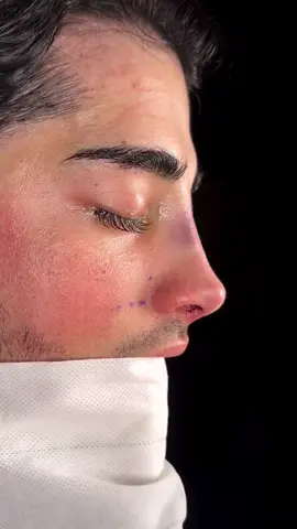 Male rhinoplasty #rinoplastia #rinoperfeccion #expertoenrinoplastia #cirugiaplastica #rinoplastiasecundaria #beforeandafterrhinoplasty #viral #ig #trending #revisionrhinoplasty #barcelonafacialplastics #drtarektraboulsi #dralbertoarecchi #rhinoplasty #rinoperfeccion  #rinoplastiasincicatriz #nosejob #resultadonatural #ultrasonicrhinoplasty #rinoplastiaultrasonica #rinoarte #rinoplastiadepreservacion #rinoplastiacerrada . Especialistas en cirugia Estética Facial, Rinoplastia y Ortognática. 📱@barcelonafacialplastics 📬info@barcelonafacialplastics.com 🔗www.barcelonafacialplastics.com ☎️ 697430303 . .