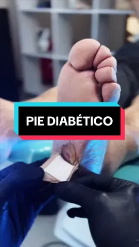 Respuesta a @MI PODÓLOGO DICE @CalzadoOnena empleado en un pie diabético. 👞 #piediabetico #calzadoparadiabetico #zapatoparadiabetico #onena #mipodologodice 