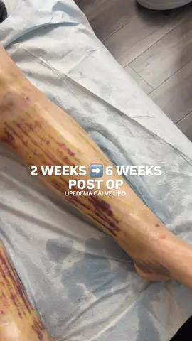 #lipedemacalvelipo #calveslipo #beforeandafterlipedemalipo #postoplipedema #beforeandafterlymphaticdrainage 