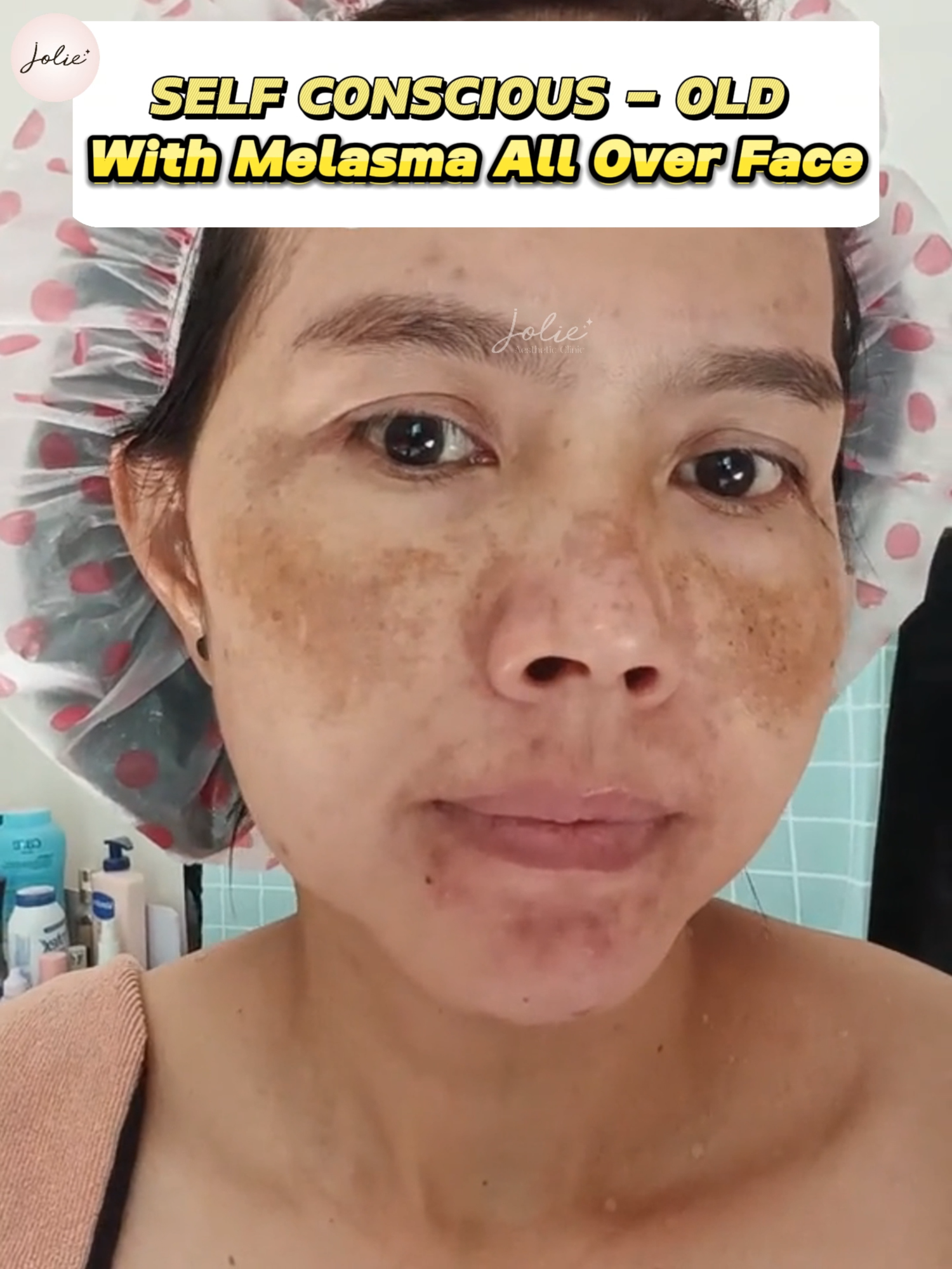 🔑BANISH MELASMA AND UNVEIL YOUR NATURAL GLOW—FAST RESULTS GUARANTEED! #joliebeauty #melasmatreatment #glowingskin #malaysia #singapore
