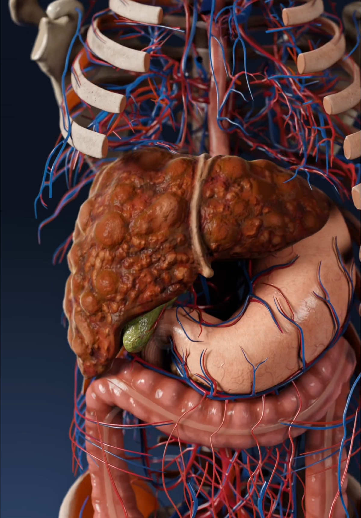 Hepatic cirrhosis in 3D: types, development, and clinical insights The liver is an extraordinary organ, performing hundreds of essential functions, from detoxification to nutrient metabolism. However, when cirrhosis develops, its intricate structure and functionality are severely compromised, often with irreversible consequences. What is hepatic cirrhosis? It’s a progressive liver disease characterized by scarring (fibrosis) and nodular regeneration of liver tissue. Over time, normal liver architecture is replaced with fibrotic tissue, leading to impaired function. The disease progresses through various stages, each with distinct anatomical and clinical features. Cirrhosis starts subtly, progressing from normal liver anatomy to micronodular subcompensated cirrhosis, where small nodules begin to form but liver function is partially maintained. As the disease advances, it can develop into macronodular decompensated cirrhosis, characterized by large nodules and significant loss of function, often accompanied by complications like jaundice and ascites. In the final stages, mixed terminal cirrhosis emerges, blending features of both types and marking the end stage of liver disease.   With VOKA 3D Anatomy & Pathology, you can explore the progression of cirrhosis through hyperrealistic 3D models. Visualizing these transformations in exquisite detail helps medical students and professionals understand the structural and functional changes that occur in each stage.   #hepaticcirrhosis #liverhealth #3danatomy #humanbody #medstudent #medicaltsudent #3danimation 