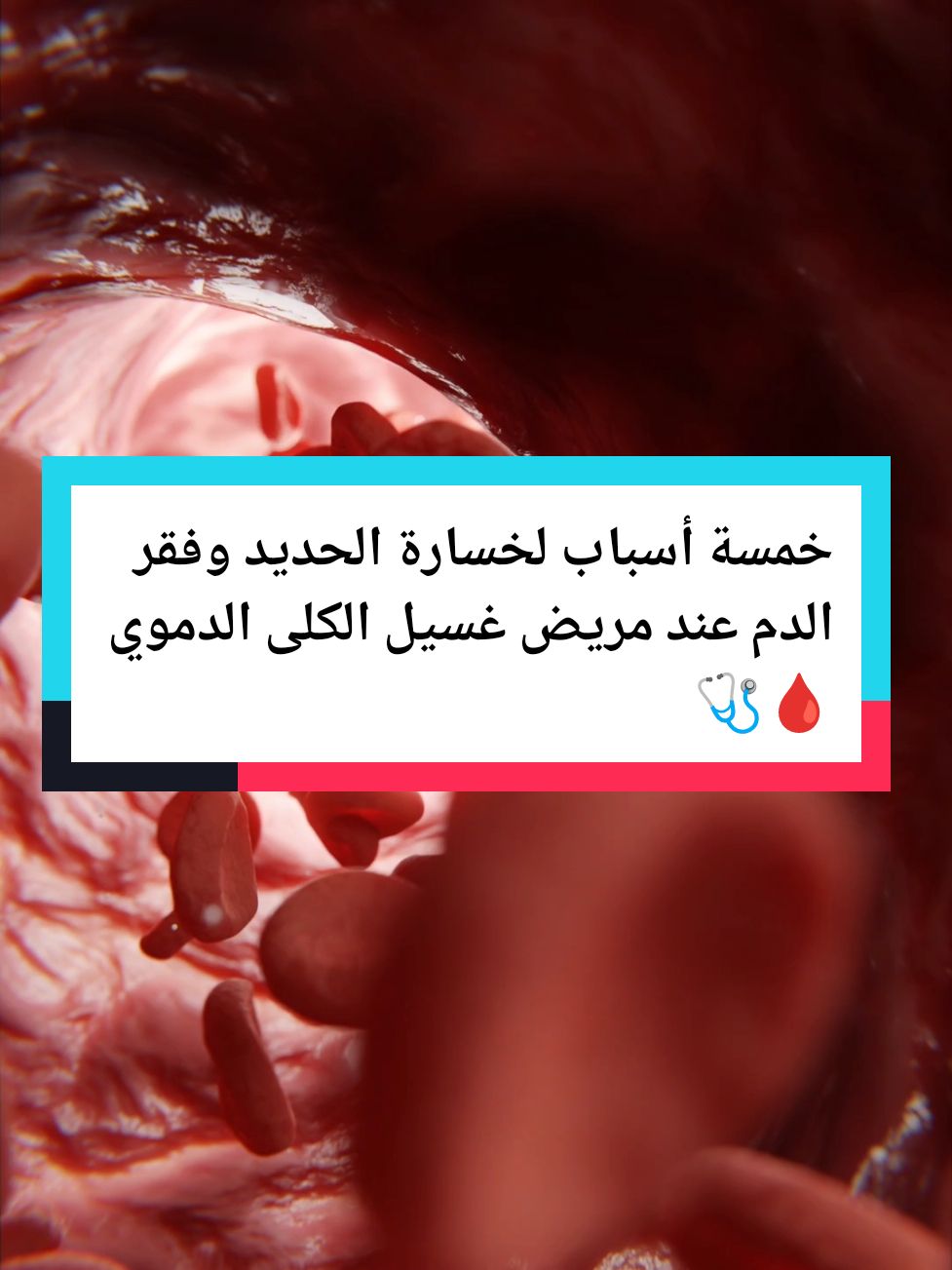 خمسة أسباب لخسارة الحديد وفقر الدم عند مريض الغسيل الدموي 🩸🩺  #الفشل_الكلوي #طبيب_تك_توك #LearnOnTikTok #تعلم_على_التيك_توك #دكتورة #مستشفى #كلى #غسيل_الكلى #غسيل_كلى #فقر_الدم 