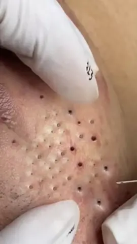 So many huge blackheads extracted🥰🥰🥰🤤🤞 #pimplepop #satisfying #foryou #pimple #blackhead #relaxing 