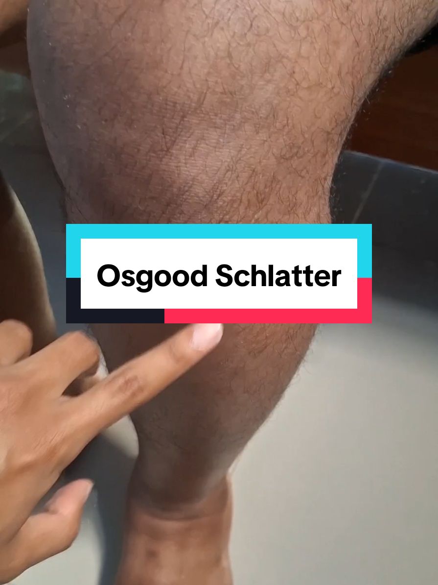 Pasien dengan kondisi osgood schlatter tampak adanya benjolan pada tuberositas tibia #osgoodschlatter #nyerilutut #cederaacl 