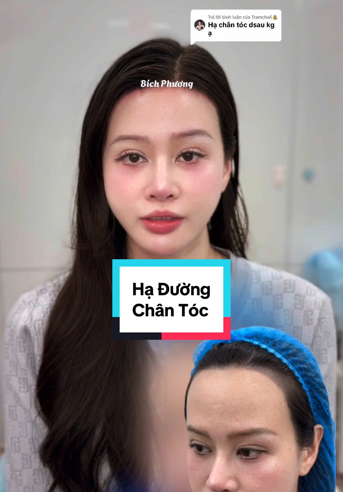 Trả lời @Tramchali💰 cảm nhận khách hàng sau khi làm hạ đường chân tóc. Tỉ lệ khuôn mặt cân đối - da vùng trán được căng trẻ, xoá nếp nhăn vùng trán và tạo đường cung trán tròn. #haduongchantoc #hạ_đường_chân_tóc #bichphuong 