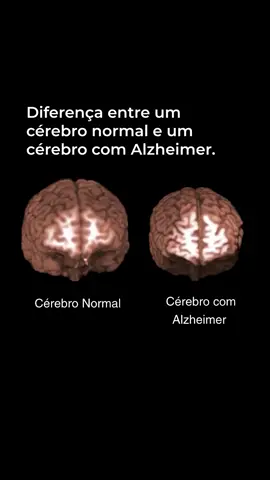 Você tem cuidado do seu cérebro? O cérebro com Alzheimer apresenta alterações significativas em comparação a um cérebro saudável, sendo uma das mais marcantes o alargamento dos ventrículos laterais, cavidades preenchidas por líquido cerebroespinhal. Esse aumento ocorre devido à perda de neurônios ao redor dessas estruturas, um processo que não acontece em cérebros normais, onde os ventrículos permanecem relativamente pequenos ao longo da vida.  Essa morte neuronal é causada pelo acúmulo de placas amiloides e emaranhados de proteínas tau, que interrompem a comunicação entre os neurônios e levam à sua degeneração. Como resultado, o cérebro perde progressivamente a capacidade de processar informações, o que explica os sintomas característicos da doença, como perda de memória, confusão e dificuldade em realizar tarefas simples.  Além disso, o Alzheimer provoca atrofia em áreas cruciais, como o hipocampo e o córtex cerebral, e reduz os níveis de neurotransmissores essenciais, como a acetilcolina. Em contraste, um cérebro saudável mantém essas funções intactas, possibilitando a realização eficiente de atividades cognitivas e comportamentais.  Essas mudanças estruturais e químicas explicam o impacto devastador da doença, que afeta não só a memória, mas também a qualidade de vida de quem convive com ela. Por isso, compreender essas diferenças é essencial para buscarmos estratégias de prevenção e tratamento. Vídeo do USC Stevens Neuroimaging and Informatics Institute.