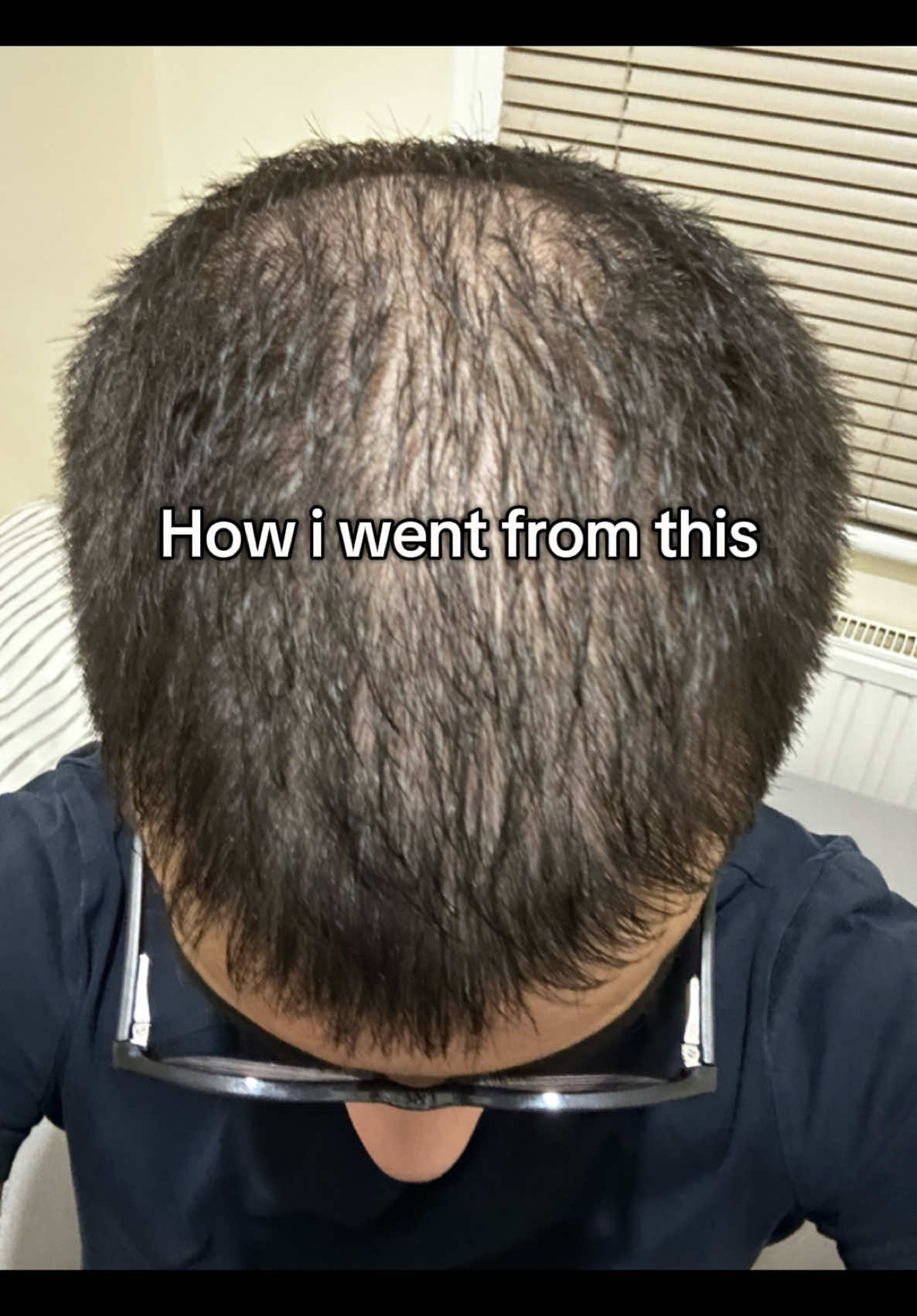 Minoxidil + Dermastsmp + pumpkin seed oil + trust the process #minoxidil #consistency #dermaroller 