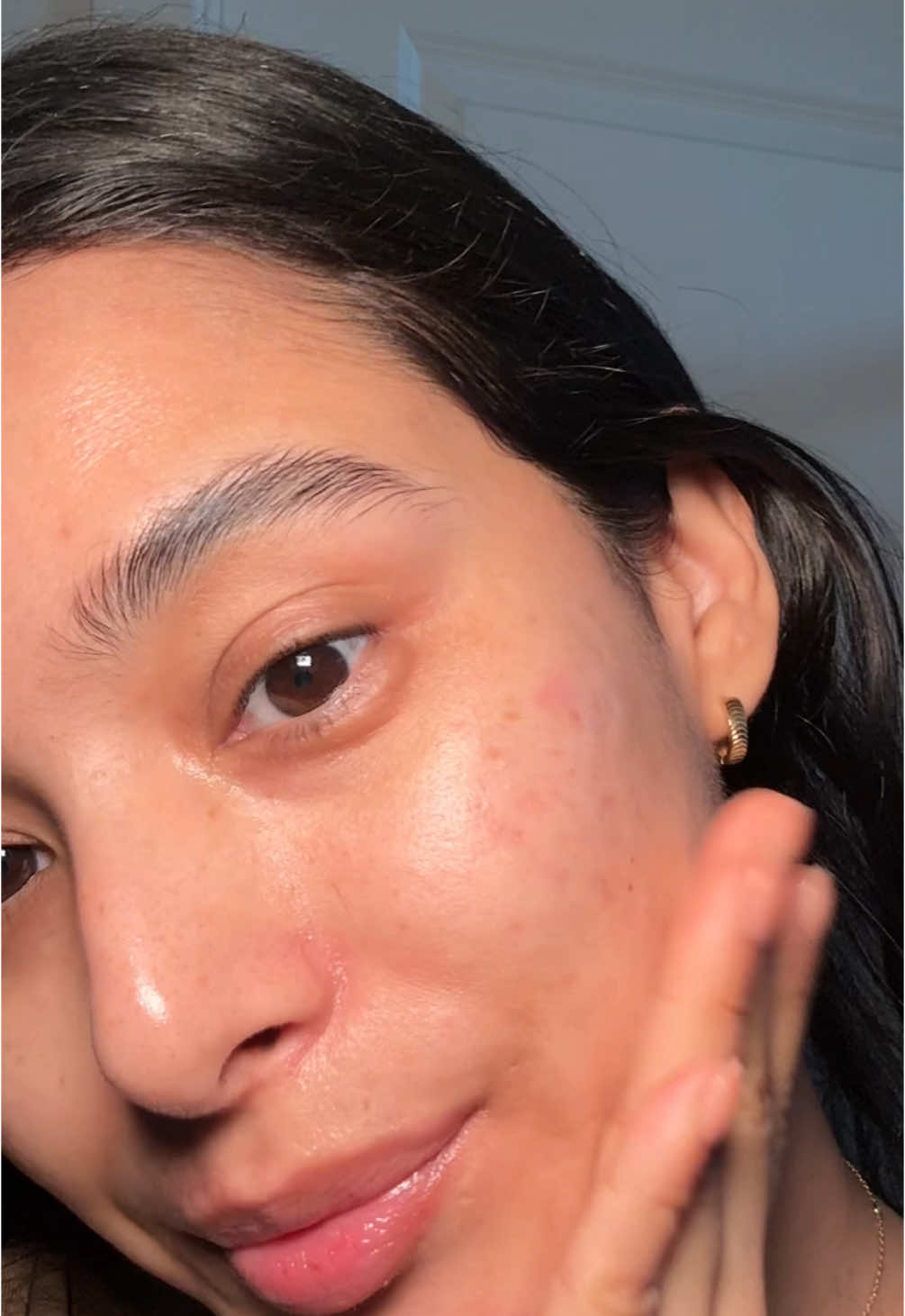 8 month skin update🫶🏽 #hormonalacne #hormonalacnejourney #skintransformation 
