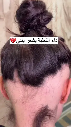 علاج تساقط الشعر #كوزمتك_الوجه_الاخر 