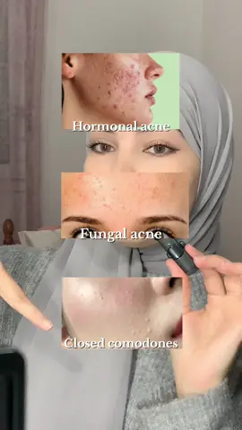 This is for educational purpose only! #fyp #acne #hormonal #fungalacne #glycolicacid #retinol 