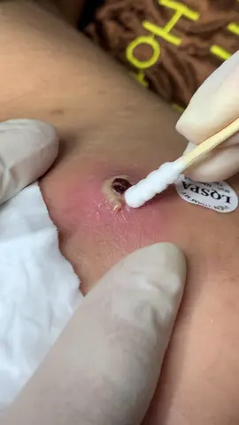 Ây daa..!! #chamsocdamun#chamsocdaseo#chamsocdanam##govap #Lequynh #Lqspa#hocnghespa  #chamsocda #lequynhspa #lequynhspahcm#vienthammylqspa#lqspabeautyacdemy#LQSPABeauty&Academy