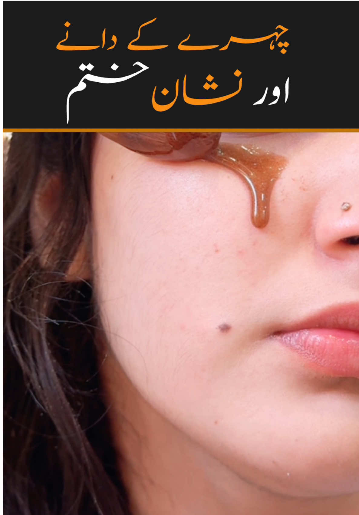 Acne scars treatment #acne #scars #skinglow #skincare #shumailasdiary 