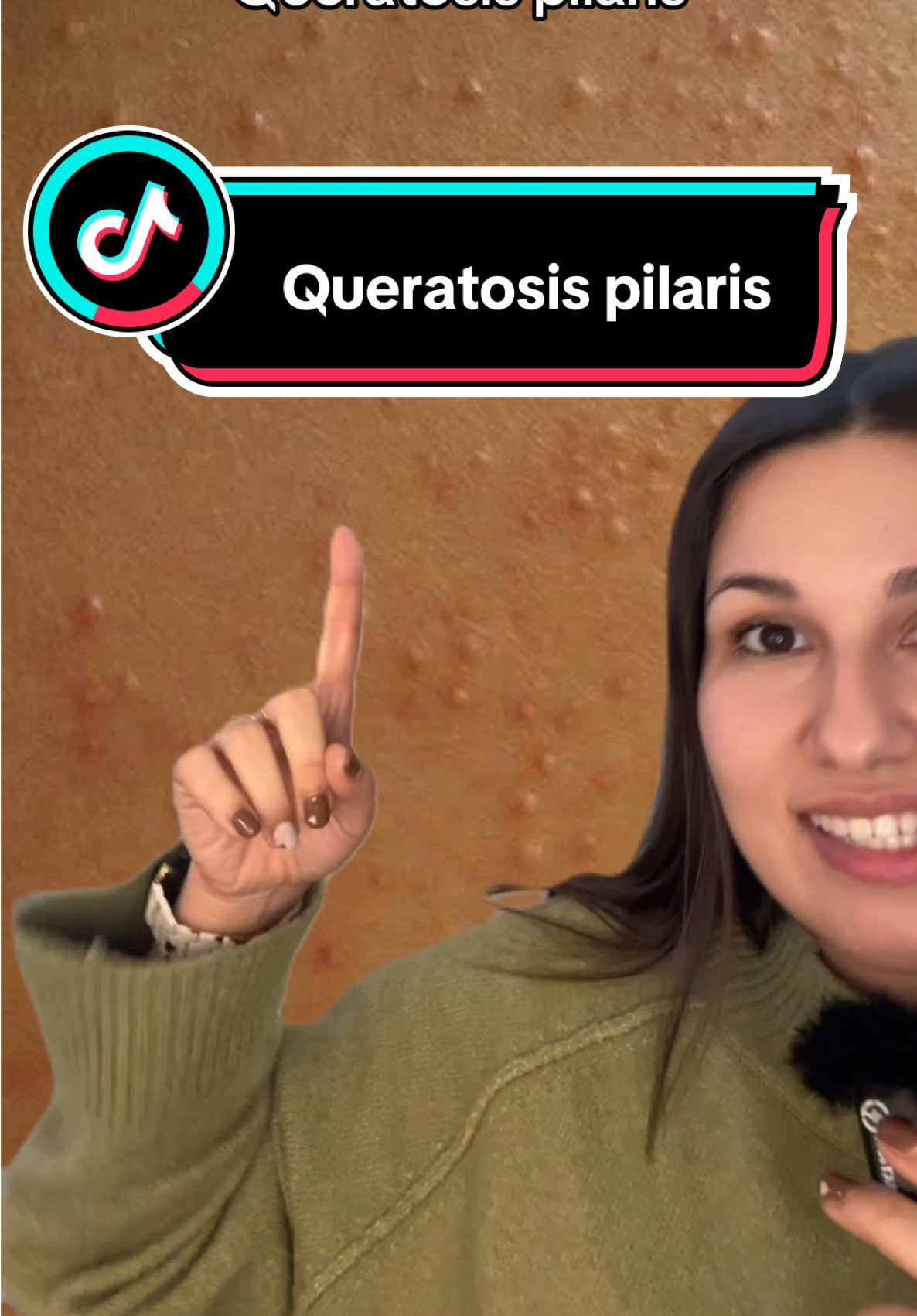 Queratosis pilaris #queratosispilaris #pieldegallina #granitos #piel #farmaceutica #farmacia 