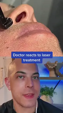 Amazing laser procedure! -- #squeezeyuk #acne #pimple #pimplepop #blackhead #satisfying #foryoupage #foryou  #تنظيف_بشره  #whiteheads #رؤوس_سوداء #عنايه_بالبشره #دهون 