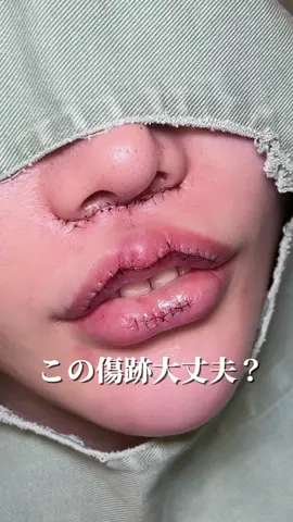 #唇 #唇整形 #M字リップ #人中短縮 #整形 #lip 