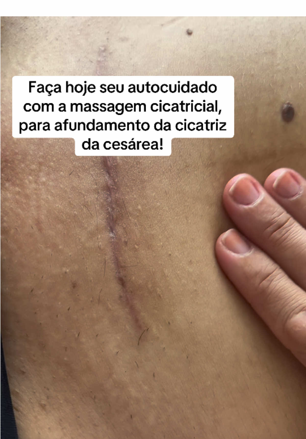 Cicatriz finda  faça isso!#RecuperaçãoCesárea #MaternidadeReal #ComunidadeDeMães #ComunidadeDeMães #CuidadoMaterno 