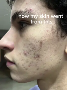 skin care and accutane are life savers #fyp #GlowUp #looksmax #transformation #skincare#CapCut 