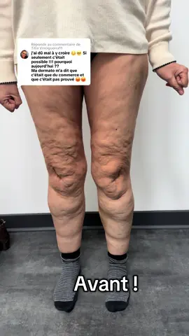 Réponse à @Titia Vinciguerra11 nos résultats parlent d’eux même ! Au cabinet daya nous combinons plusieurs technologies,  de pointe pour arriver à des résultats aussi exceptionnels. . Et pour cette patiente nous  avons pas encore fini le protocole . On continue les soins pour encore plus de résultats 💪 #pourtoi #celulite #pertepoids #cryolipolyse #avantapres #radiofrequence #emsculpt 