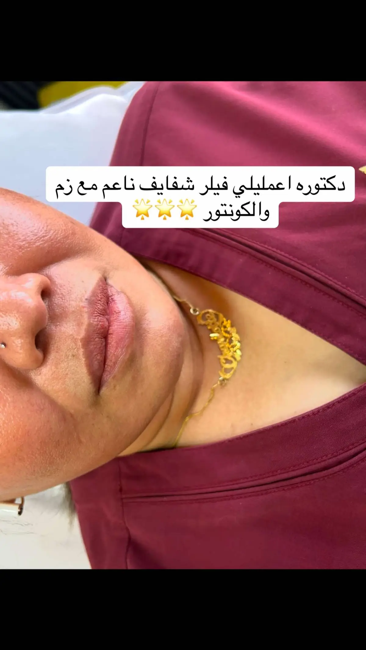 جمال فيلر الشفايف مع دكتوره مي عادل 🩼🩼⭐️⭐️⭐️ 📍عياده ابتسامه النجوم فرع التحليه بجده للحجز 0545222306#ابتسامه_النجوم #اكسبلورexplore #افضل_دكتوره_بجده #بوتوكس_فيلر #فيلر_شفايف #المشاهير #fyyyyyyyyyyyyyyyy #فيلر 