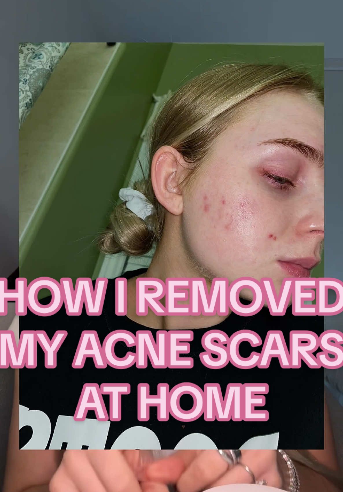 How I removed my acne scars and hyperpigmentation at home!🤩🫶🏼 @NEOGEN GLOBAL #acneproneskin #skincareroutine #acnescars #neogenpartner #affordableskincare  