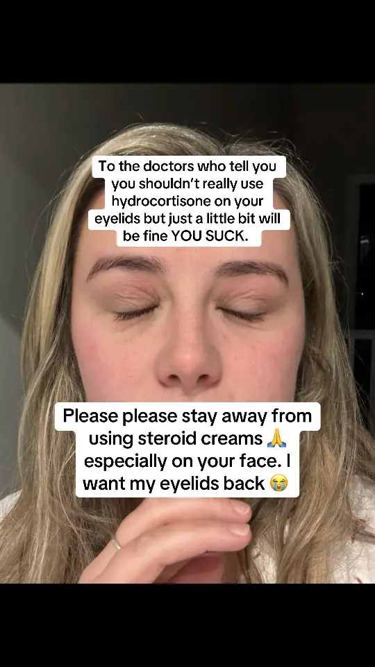 #tsw #eyeliddermatitis #ezcema 