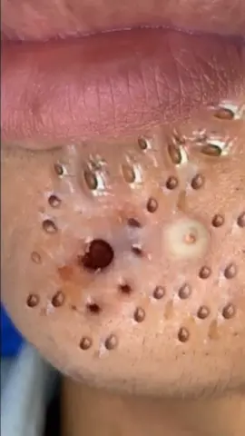 CRAZY SATISFYING BLACKHEAD REMOVAL  #pimple #blackheadsremoval #viral_video #satisfyingvideo #blackhead #blackheads 