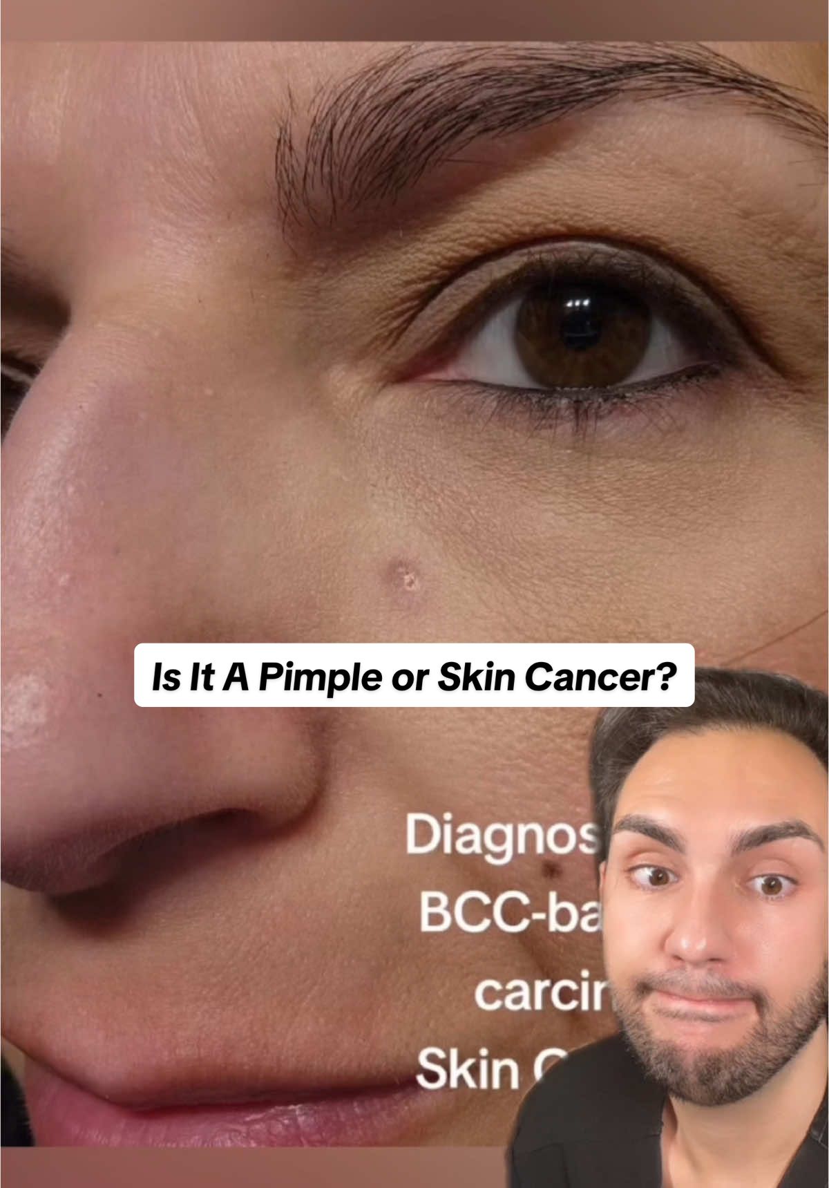 A “Pimple” That Doesn’t Go Away Whenever you’re dealing with a “pimple” (lesion) that never goes away, you shouldn’t panic, but it might be good to have it examined.  Skin cancer does NOT always look like a funny mole! #diysunscreen #naturalsunscreen #sunscreen #antisunscreen #sunprotection #skincancer #skincancerawareness #melanomaawareness #medicalaesthetician #medicalaesthetics #aestheticnurse #dermnurse 