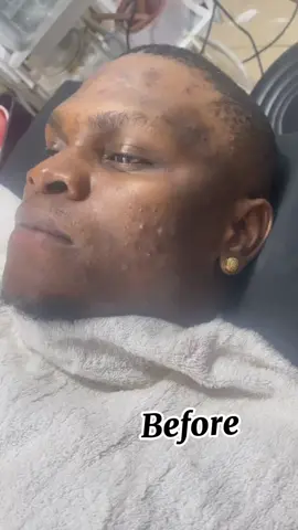 Acne Treatment progress on a client🥰 Before and after in clinic treatments & well curated home care products and a routine! Our Detty Xmas sales is still one besties Get 20% off all treatment by clicking the link in our bio to book your session. Visit us today!!! #scarletglowbeautyspa #acnejourney #acneproneskin #satisfyingvideo #glowingskin #facialstreatment 