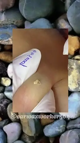 Big Cyst By Loan Nguyen Spa #short #pimplepop #blackhead #satisfying #squeeze #squeezeyuk #acne #pimple