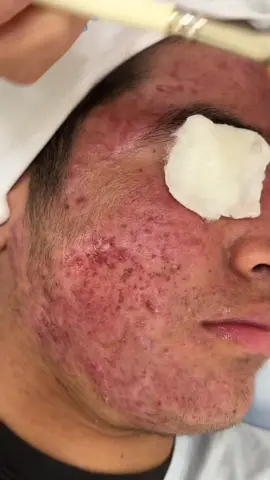 Paciente Dyron 🥰 #fypp #fypシ゚ #acneskin #rocutan #acnetreatment 