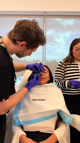 Nose reveal 👃🏼 #rhinoplasty #nosejob #plasticsurgery #nose #surgery #castremovalday #journey #fyp #fypシ #viralvideo 