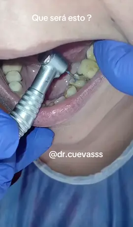 #paratiiiiiiiiiiiiiiiiiiiiiiiiiiiiiii #viraliza #virał #amazing #teeth #tipsdentales #awesom 