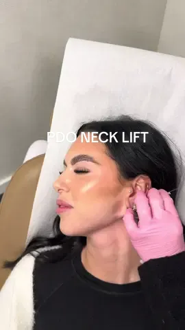 Necklift using PDO threads👏  #pdothreads #pdothread #pdothreadlift #pdonecklift 