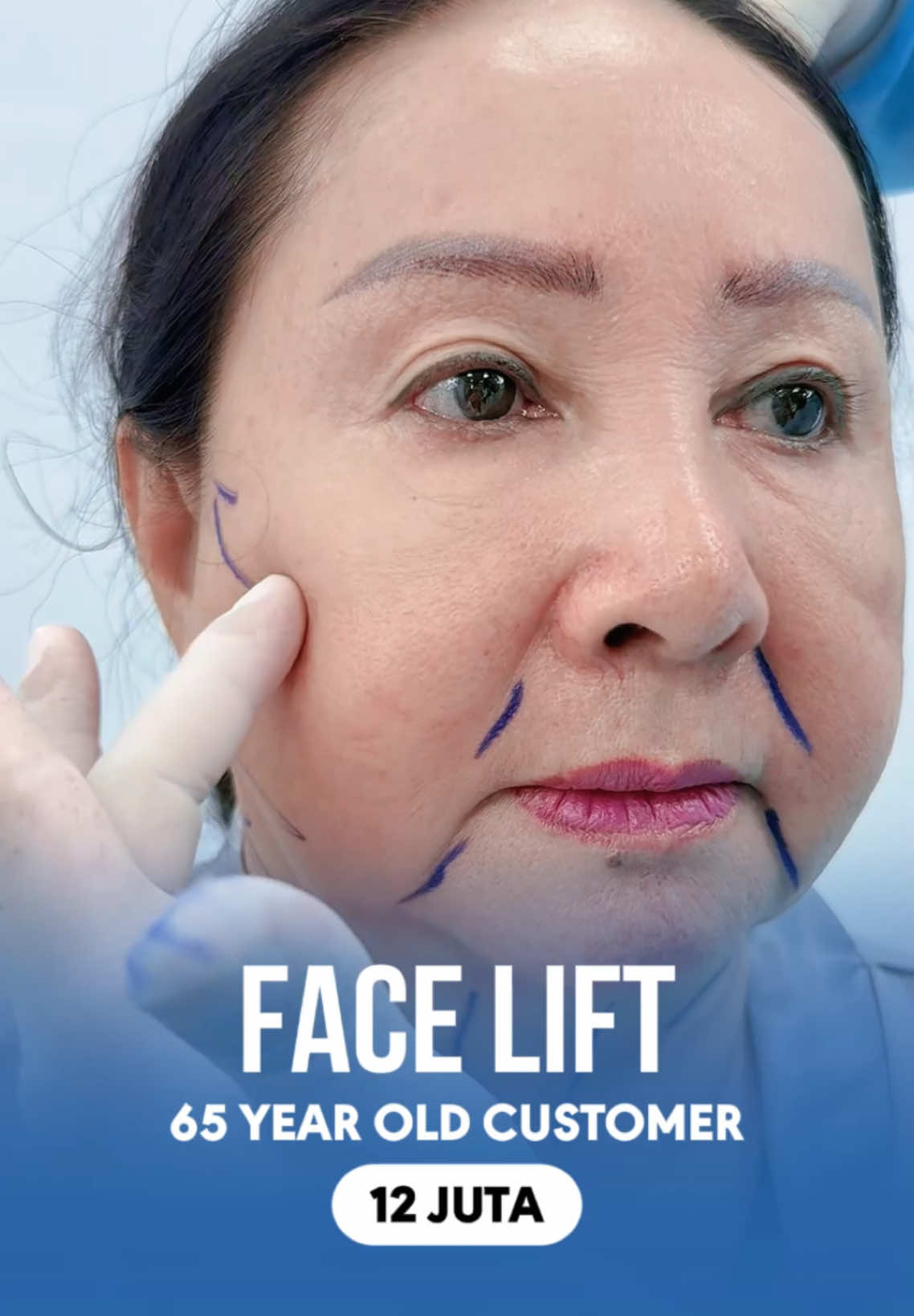 Anda tidak akan membayangkan bagaimana perubahan Anda setelah operasi facelift #SiapaSangka #favelifting #faceliftmini #faceliftfull #lips #mata #hidungsumbat #flypシ #facelift #lipsbeauty #eyelid 
