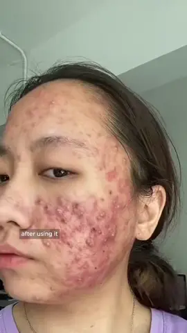 Salicylic Acid Anti-Acne Cleanser facial,Wash refreshing our face and reduce oil production and reduce ane!#acne #acnetreatment #acneskin #Antiacne #facialwash #salicylicacid #facialcleanser #oilcontrol