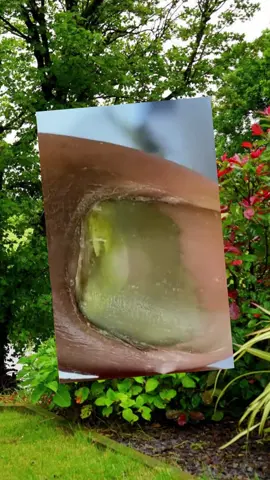 #toenails #ingrowntoenail #toenailremoval #nails #toenail #satisfyingvideo #fyp