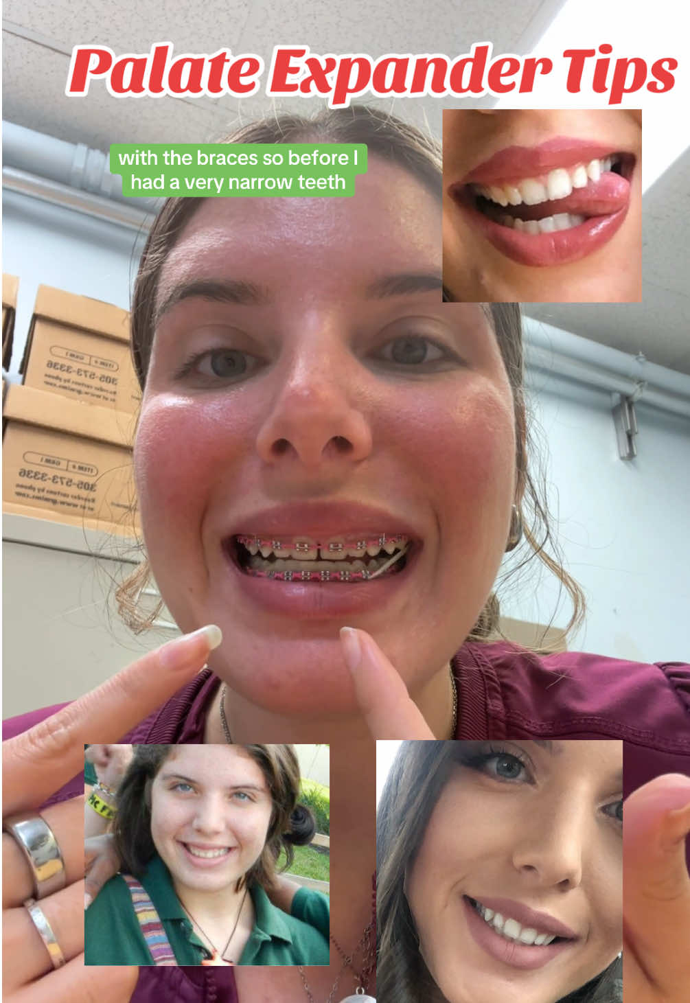 Hope all the tips help ! Once my journey ends ill post full before and after. Frok the old pictures i insterted yall can see i had a very narrow palate , my bite is off and im very gummy #palateexpander #braces #adultbraces #bracesjourney #sarpe #bracestips #expander #expandertips #fy #foryoupage #fypシ゚viral #orthodontist #dentist #oralcare #narrowpalate #gummysmile 
