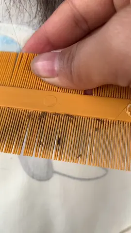 I want to get rid of lice 😭😱#omg #lice #liceremoval #trendingvideo 