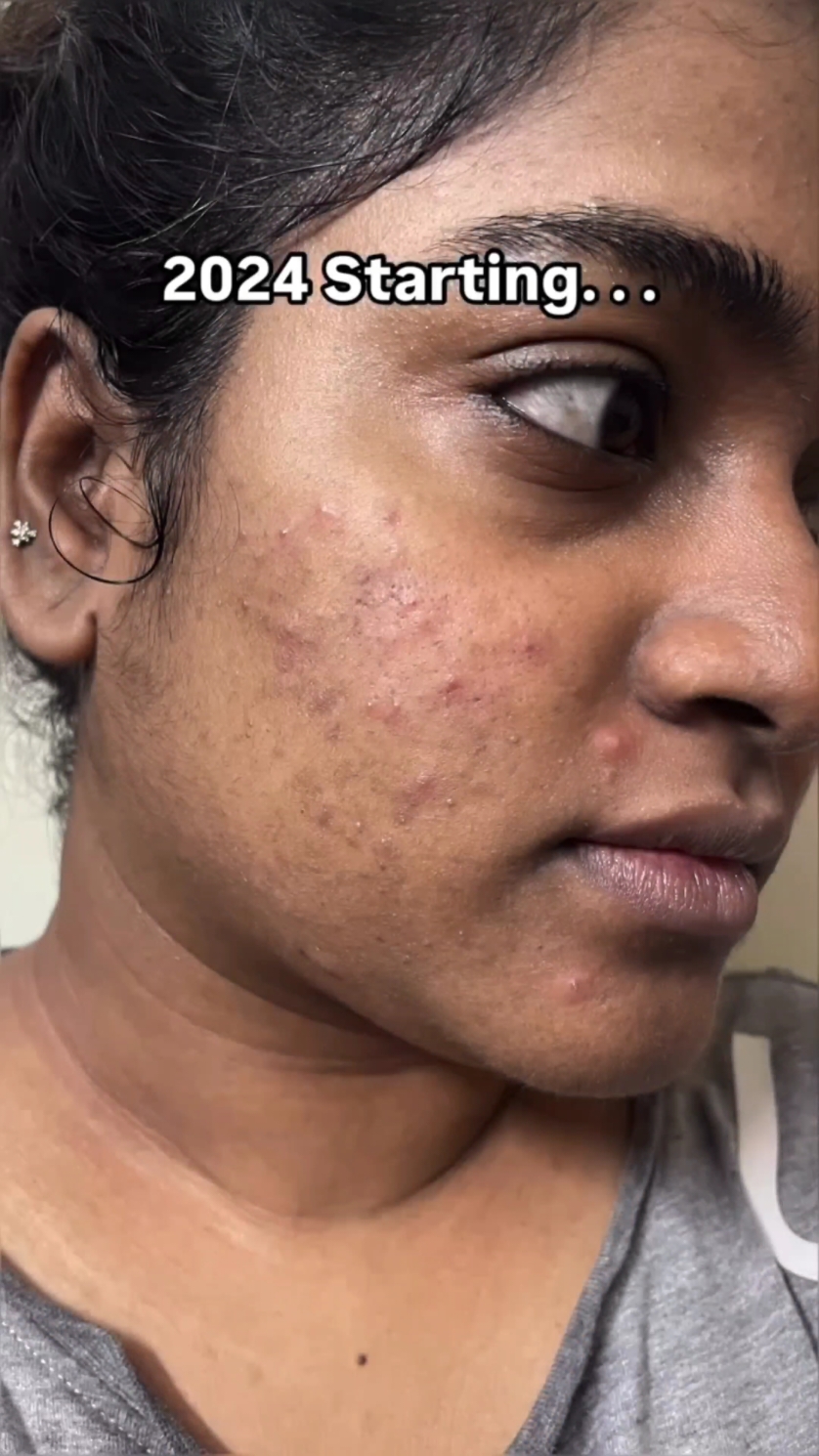 anua niacinamide serum  Skin care product review  Hi To confirm your order please inbox us our Instagram and Facebook page  Instagram -authentic_cosmetic Facebook -Authentic cosmetics  #offer #cosrx #Theordinary #ceravc #Neutrogena #acwell #Aveeno #Avene #Bioderma #beautyofjoseon #authentic_cosmetics #Flicker #beautytrend #skin #skincareproducts #skincare #skincaretips #Skincare #skincaretips #BeautyTrend #Flicker #cosrx #Theordinary #ceravc #Neutrogena #acwell #Aveeno #Avene #Bioderma #beautyofjoseon  #Authentic_cosmetic