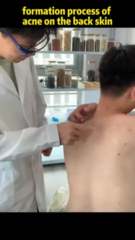 formation process of acne on the back skin#quarxery #bodywash #Moisturizing #Acne #clean #antiperspirant #sudor #antitranspirante #desodorante #sudoracionextrema #deodorant #hiperhidrosis