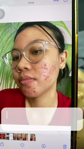 Điều trị Mụn trên nền da yếu, bùng viêm #Kbeautyspa #dieutrimun 
