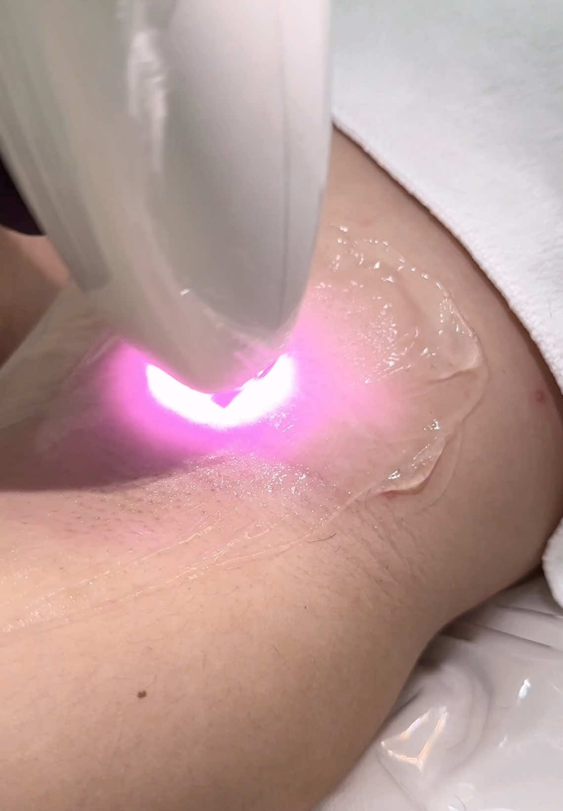 📍Tại EMLY chỉ cần 1 buổi triệt cho chiếc nách bay sạch violong! Tạm biệt lông chưa bao giờ dễ dàng đến thế🥰🗯Ib cho EMLY nhận ngay suất triệt trải nghiệm chỉ 𝟔𝟗𝐤 #trietlonglanh #trietlongdanang #trietlongnach #trietlong #spadanang #Emlybeauty