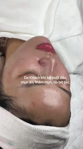 🌿 Cải thiện làn da mụn ẩn, bít tắc, và thâm mụn chỉ sau 2 buổi, sự khác biệt thế nào nếu làn da được chăm sóc đúng cách.  #homespa #viral #trịmụn #KOTAbeauty 