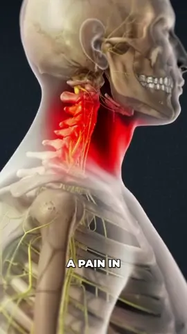 A cervical transforaminal epidural steroid injection involves injecting a pain-relieving medication into the epidural space around the spinal nerves in your neck. #spinalnerve #steroid #injection #spinalnerves #medicaleducation #medicalanimation #3danimation #3dmedicaleducation #3danimationsurgery