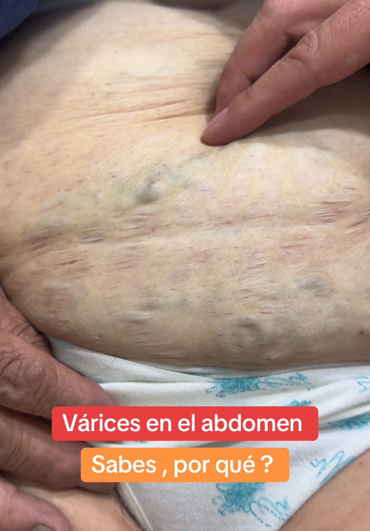 🏩 Las Várices pélvicas ☺️👆 pueden ocasionar: dolor en la parte inferior del abdomen , dolor dirante las relaciones sexuales , pesadez en las piernas @The Vein Doctor 👨‍⚕️ visitanos , podemos ayudarte 👉 Ecuador - Riovasc - Riobamba 👈📲+593995178395/+593958757917 #varices #varicesenlaspiernas #venasvaricosas #varicesyarañitas #arañasvasculares #cirugiavascular #cristianbravo148 