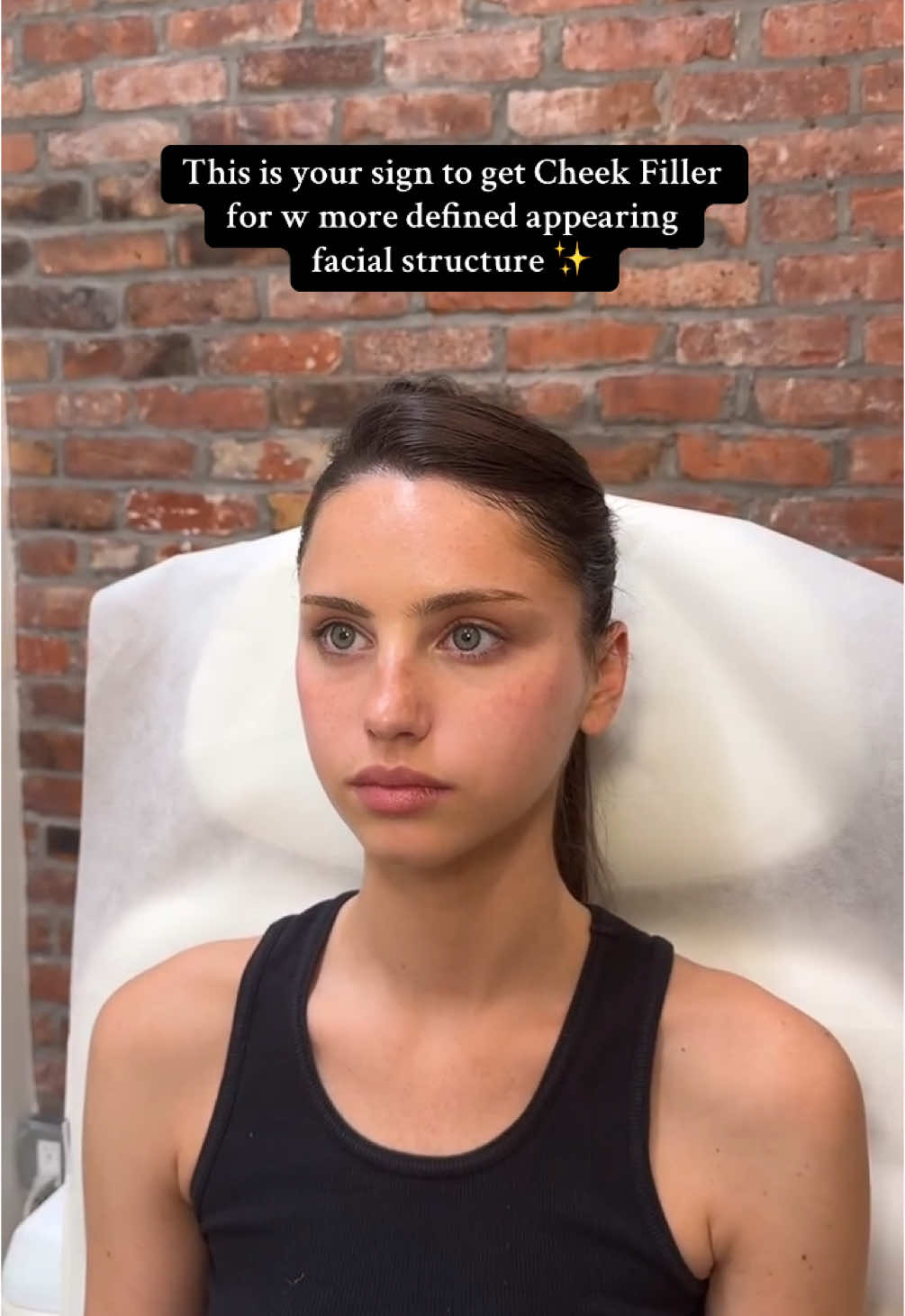 Acheive a more plump & contoured look with #CheekFiller 😍 #injectables  