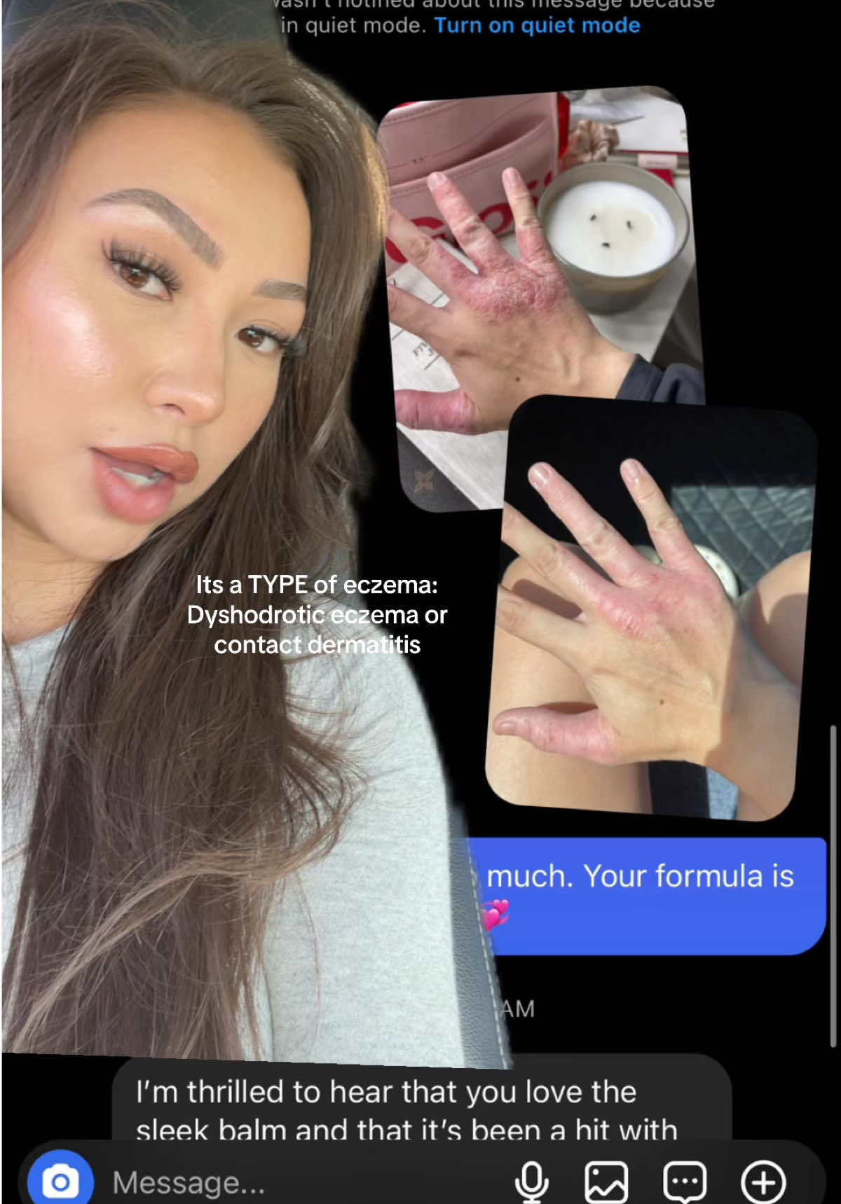 Had anyone gone through this? I got a SEVERE allergic reaction and eczema flare up to acrylic and gel nails…It resulted in a longterm battle of constant unbearable pain and swelling in my fingers. I thoight i just had to accept the fact that ill deal with it forever. Im so happy that i found this soothing protective balm. Id chose this over any other cream i’ve had!!  #allergicreaction #eczema #s#sensitiveskinstorytime #acrylicnails #eczemaawareness 